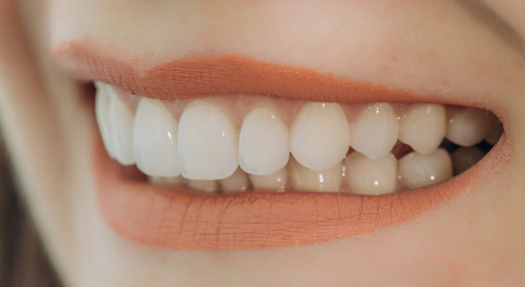 a woman smiling to show her veneers
