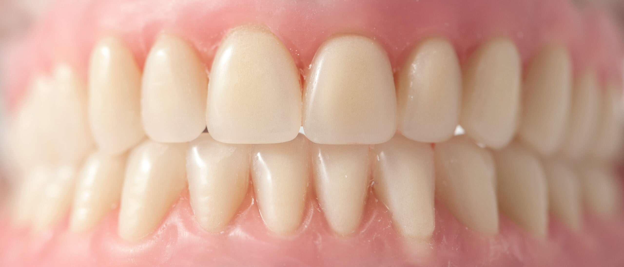 Dental Implants Versus Dentures Lee Trevino Dental 