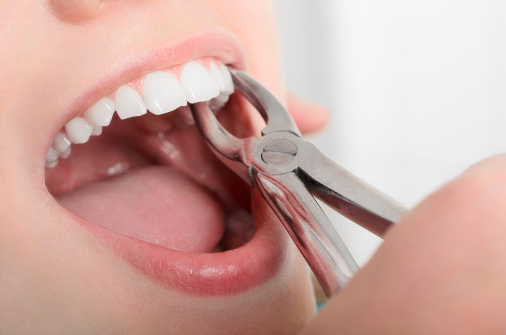 dentist removing tooth from a patient's mouth with dental tools