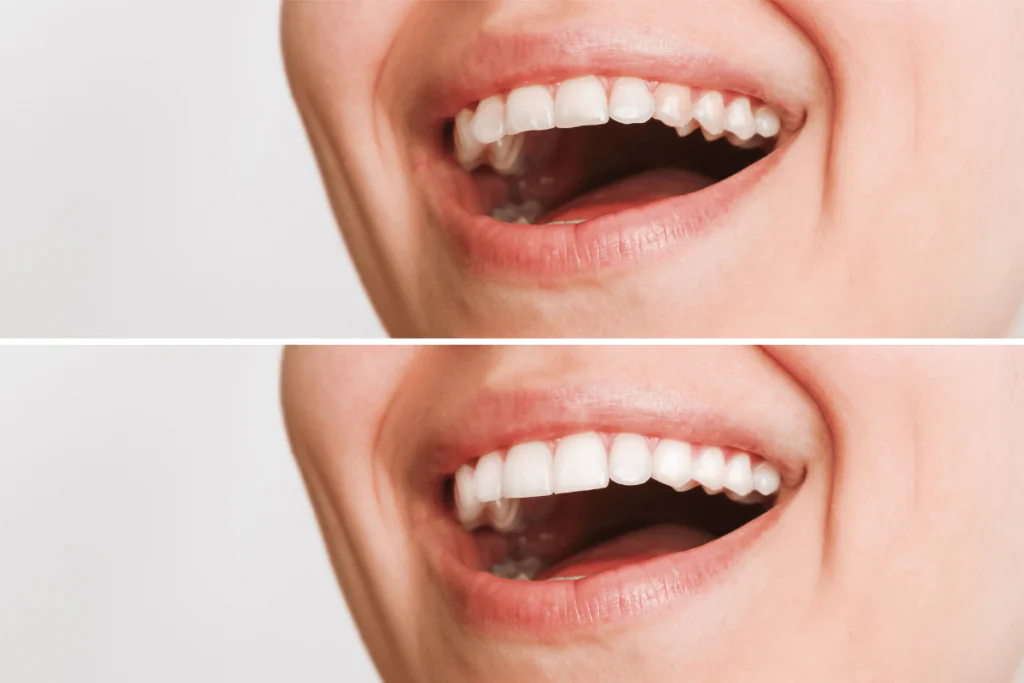 A woman smiling with new veneers
