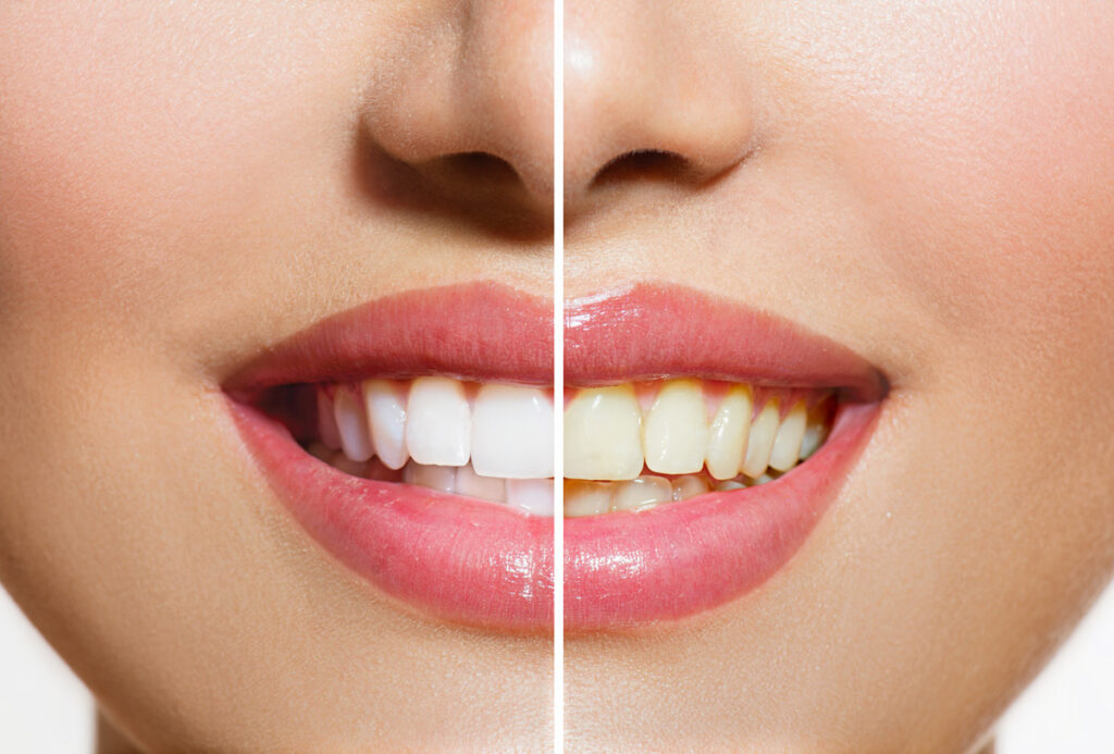A close-up comparison of a woman’s teeth, one side of her teeth is white and the other is yellow.