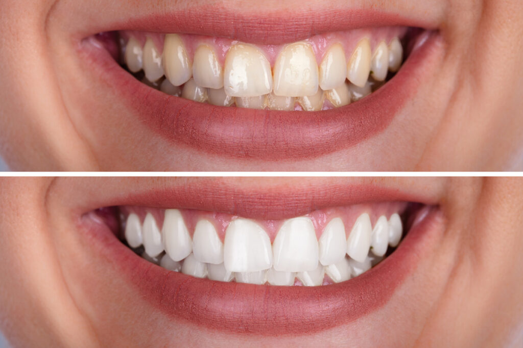 A before and after of yellow teeth turning to white teeth in El Paso.