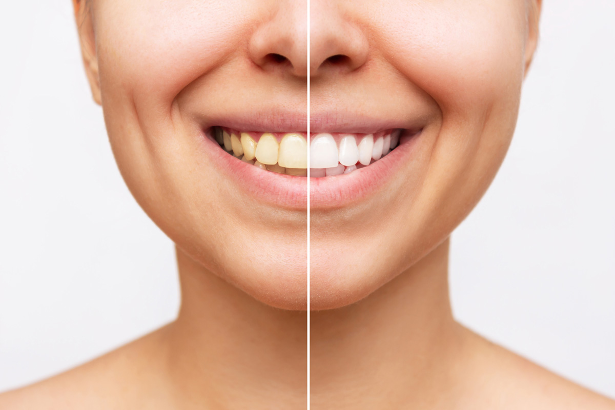 A person smiling showing the before and after results of teeth whitening in El Paso.